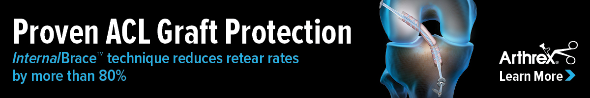 Arthrex InternalBrace ACL Reconstruction